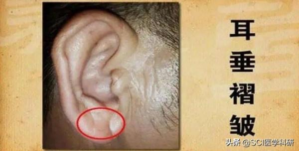 耳朵上有這道紋要警惕心臟健康