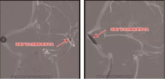 莫名頭痛伴視力模糊，竟是靜脈竇狹窄！支架置入“天塹變通途”