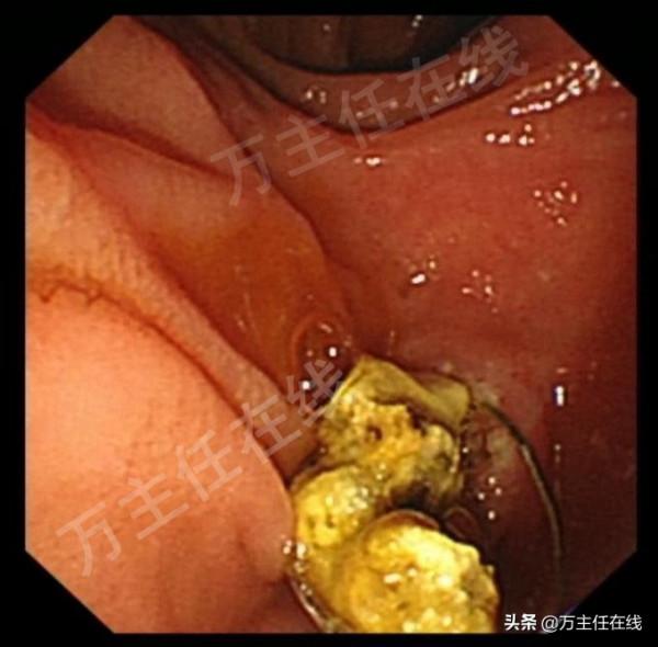 孕34周腹痛入院，多科通力合作挽救膽管結石伴膽管炎妊娠晚期孕婦
