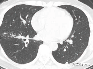 咳嗽半年反覆肺炎為什麼治不好 細看影像發現端倪緣是異物堵塞
