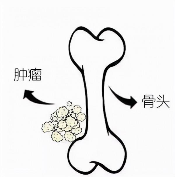 你以為孩子是“生長痛”，誰知竟會是骨腫瘤