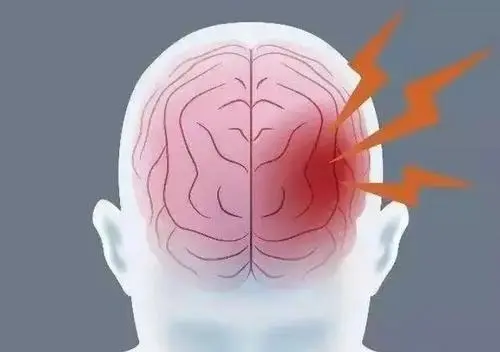 身邊有人腦梗該做些啥？抓住“黃金時間”