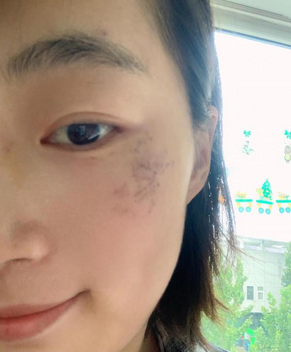 鐳射祛斑第八天 鐳射祛斑第八天