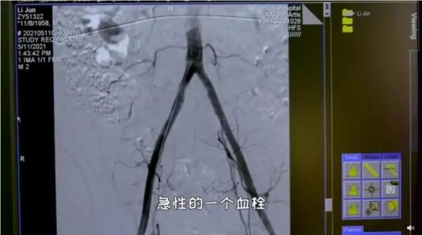 健康 | 年齡每增長10歲，“腿梗”發生率增加2倍！這些人群要警惕