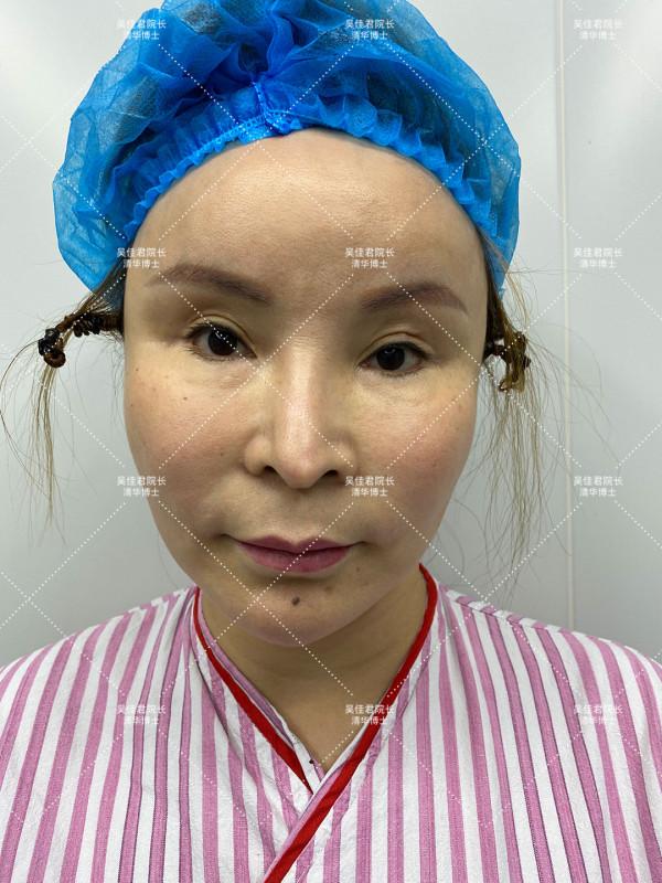 40多歲做小拉皮真實經歷,術後6個月效果很驚豔 40多歲做小拉皮真實經歷,術後6個月效果很驚豔
