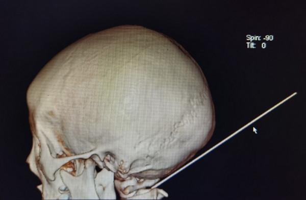太嚇人！寫作業時父子起爭執，鉛筆竟插入8歲男孩後腦勺