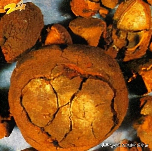 聊一聊治療冠心病的常用中成藥——麝香保心丸