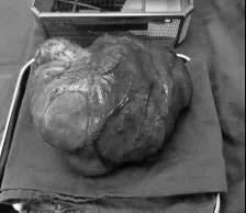 11歲女孩腹部惡性腫瘤破裂，&OpenCurlyDoubleQuote;驚魂&rdquo;24小時轉危為安！兒童腫瘤自查，學起來