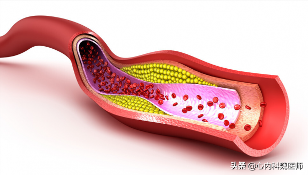 冠心病患者服用這3類藥物，可以有效預防心梗，提高生活質量