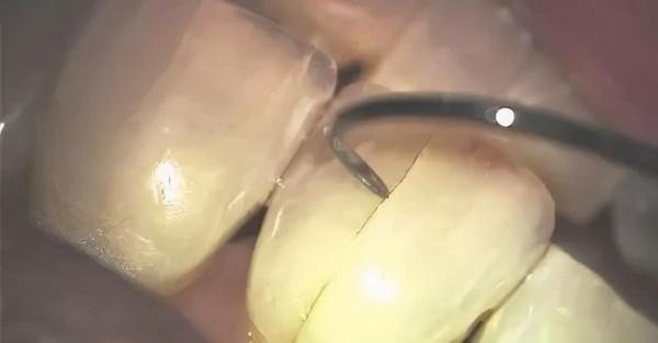 你的牙正在悄悄開裂