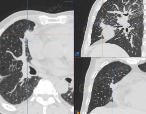 肺結節看診（13）：肺小結節全身廣泛轉移2例，PET分期：晚期