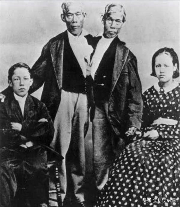 連體人一個去世怎麼辦？連體姐姐死後，妹妹被迫和遺骸生存2天