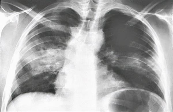 鸚鵡熱只是一種鳥病嗎?7名患者1例醫治無效,醫生帶你瞭解一下 鸚鵡熱只是一種鳥病嗎?7名患者1例醫治無效,醫生帶你瞭解一下