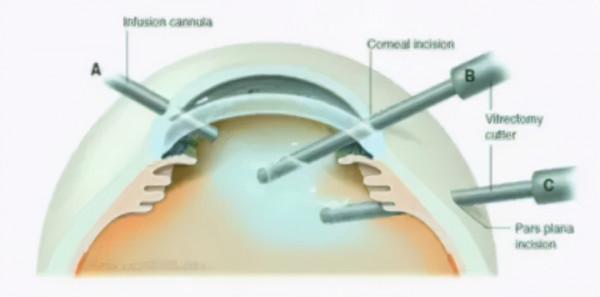 千里之行，始於足下——白內障手術解剖基礎及玻璃體切除相關裝置