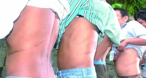 尼泊爾賣腎村:2000元能買一個健康腎,幾乎人人身上都有一道疤 尼泊爾賣腎村:2000元能買一個健康腎,幾乎人人身上都有一道疤