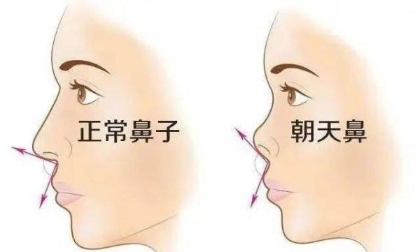 一個好看的鼻尖對於隆鼻來說真的很重要