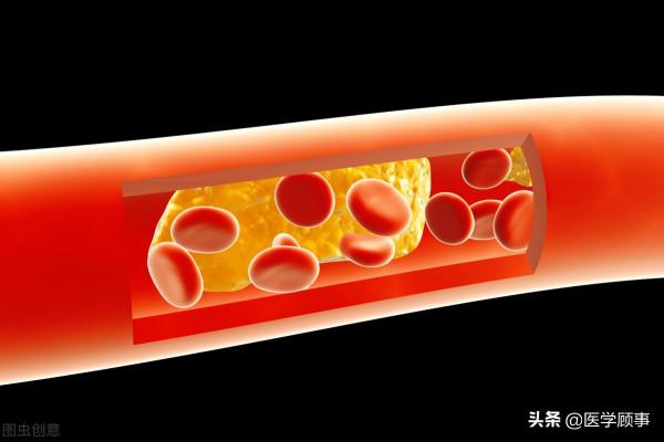 Stroke：取栓後立即進行CT灌注檢查的意義