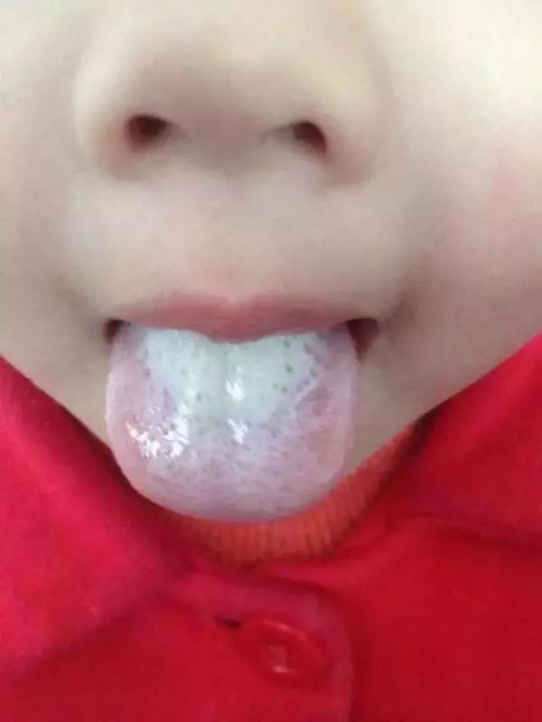 幾種常見的小兒舌象，家長們要多多注意了