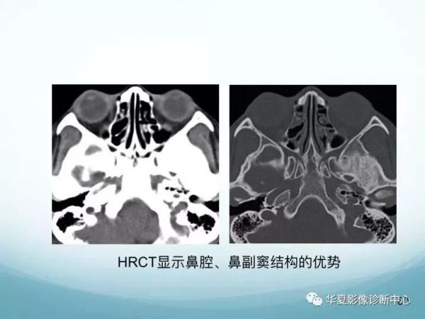 頭頸五官CT斷層解剖圖及常見病影像診斷