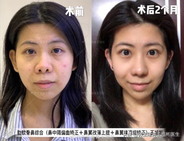 鼻頭縮小可以只“減脂”，不取自體軟骨做支架嗎？