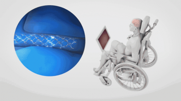 首位植入腦機介面的患者透過Twitter釋出資訊