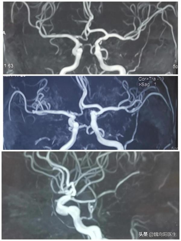 奔著做支架來醫院，最後發現是血管變異引起，避免了一場大手術
