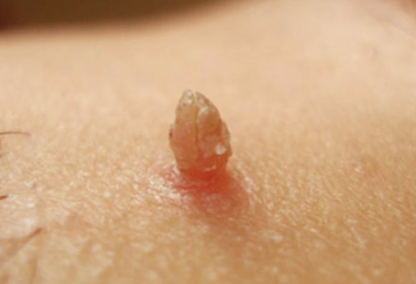 面板上的小肉球、小肉疙瘩是什麼？7種可能，情況有好有壞