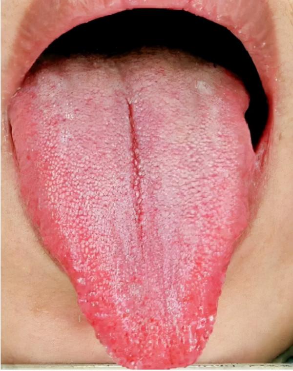 有多少脾虛,是因為肝鬱? 有多少脾虛,是因為肝鬱?