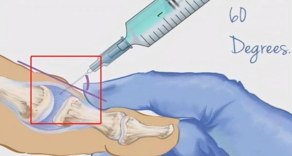 封閉針，究竟是“毒”還是“藥”？聽聽醫生怎麼說