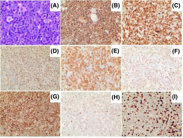 蘇州大學附屬第一醫院黃海雯教授:應用R2-CHOP方案有效治療罕見的四打擊多形性套細胞淋巴瘤的病例報告 蘇州大學附屬第一醫院黃海雯教授:應用R2-CHOP方案有效治療罕見的四打擊多形性套細胞淋巴瘤的病例報告