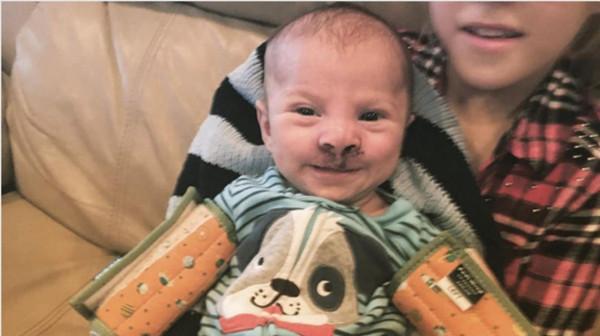 父母不顧醫生建議拒絕墮胎，重度唇顎裂的寶寶現在長成美男了