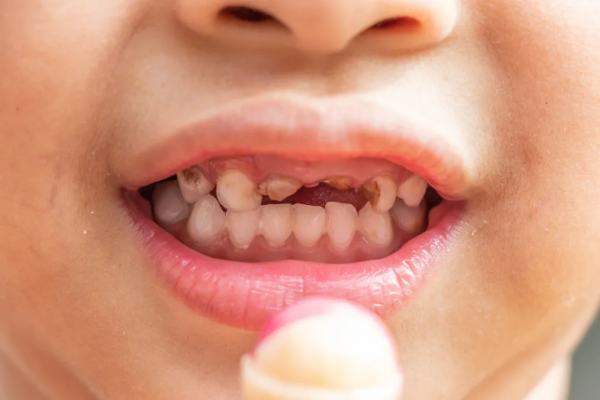 10個寶寶7個齲齒，刷不到這3個地方，天天刷也白費