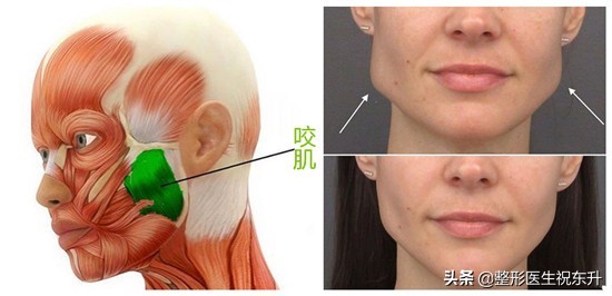我打瘦臉針“差不多有10年”了,分享真實經驗 我打瘦臉針“差不多有10年”了,分享真實經驗