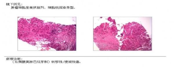 愈見未萊 | 赫帕雙靶新輔助治療HER-2+可手術乳腺癌患者，療效和安全性兼可得