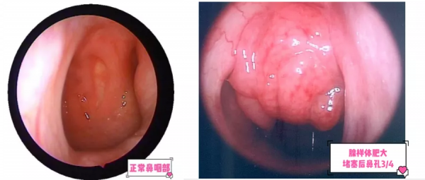 娃睡覺張嘴越長越醜？很多小孩都有的腺樣體肥大，一文說清