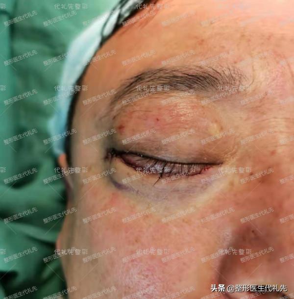 最值得35~70歲男士做的眼周年輕化術式－外路祛眼袋手術