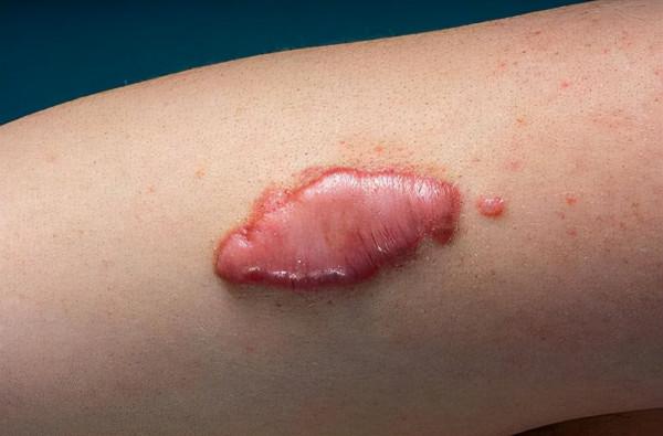 用什麼藥可以去凸性增生疤痕？