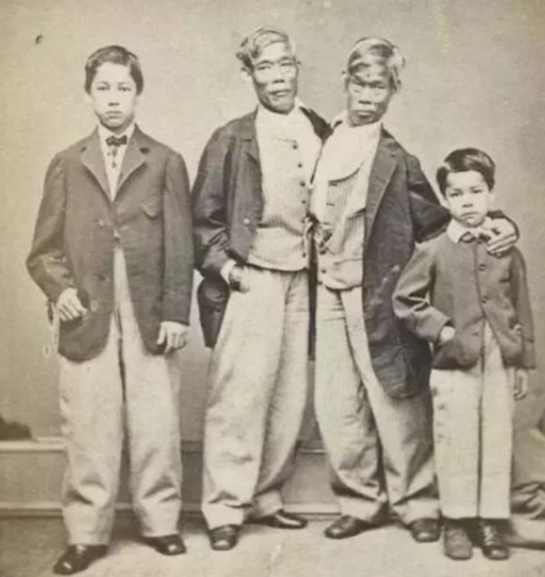 連體人一方去世怎麼辦?連體哥哥死後,弟弟在驚恐中活了2個小時 連體人一方去世怎麼辦?連體哥哥死後,弟弟在驚恐中活了2個小時