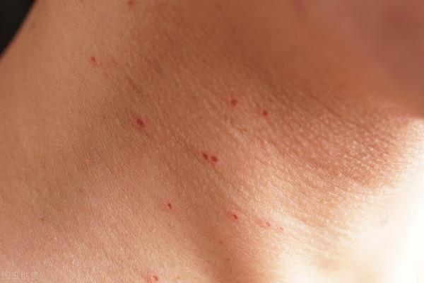 夫妻雙雙感染病毒！醫生：恐有癌變風險，面板的這4種異常要警惕