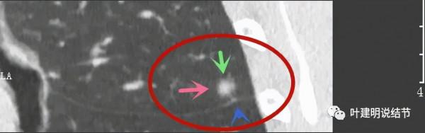 指南說小於5毫米的肺結節不需要隨訪，打臉來了