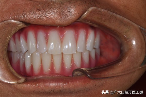 過來人告訴你,多顆牙齒缺失,這個辦法更省錢、效果更好 過來人告訴你,多顆牙齒缺失,這個辦法更省錢、效果更好