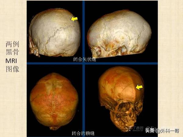 小兒顱縫早閉的診斷治療