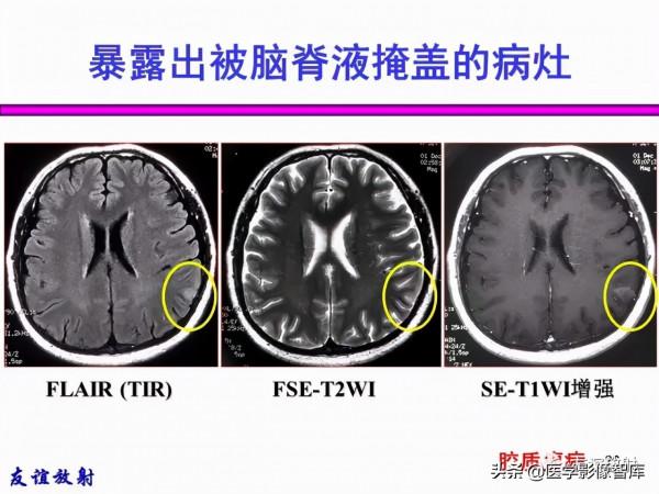 臨床MRI訊號分析基礎：常規序列及DWI序列