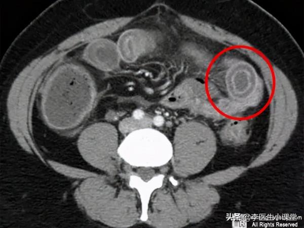 常見又罕見的克羅恩病，極易被誤診為腸胃炎，一旦患上將無法治癒