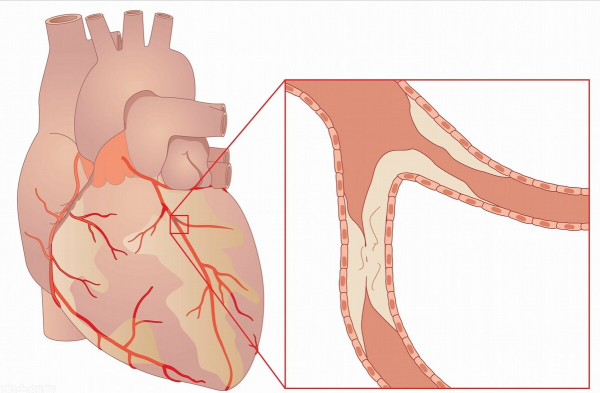 2箇中成藥，降血壓血脂、抗動脈硬化、改善冠心病，保護心血管