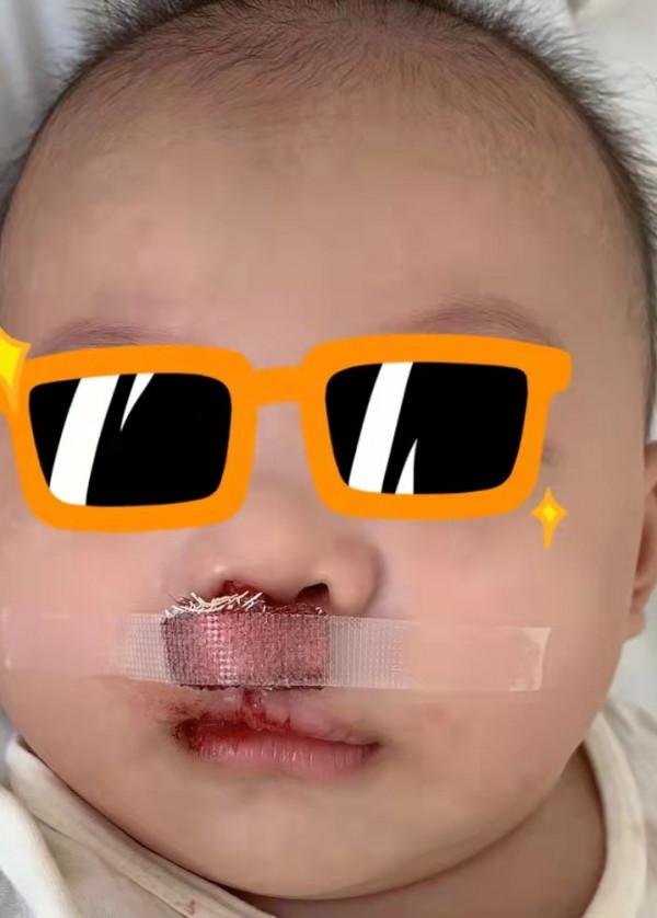 寶寶是一隻“小兔子”，還沒長牙就要開始正畸了