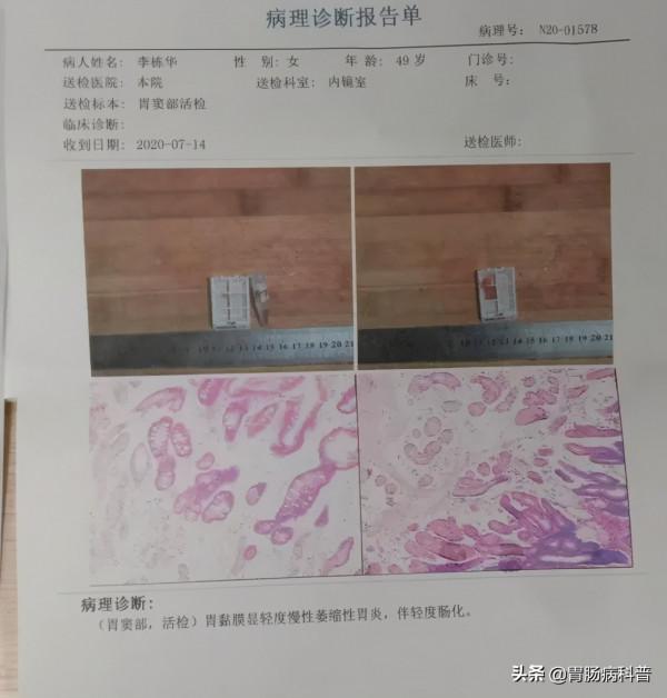 葉酸與萎縮性胃炎 葉酸與萎縮性胃炎