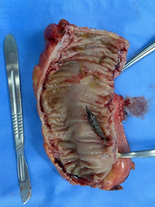 吃棗吃進ICU？這些食物要小心了