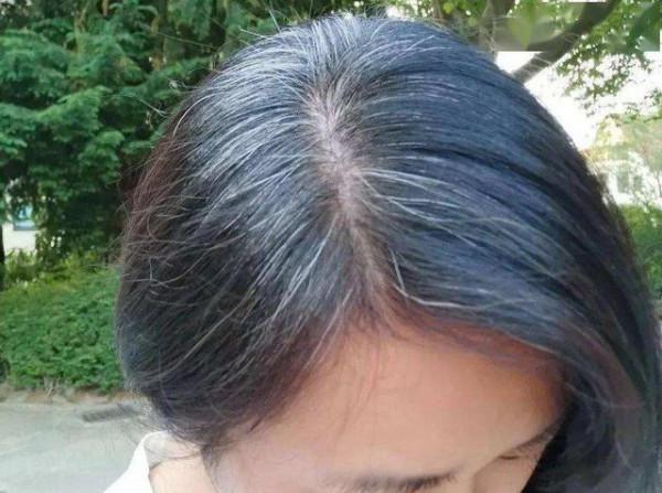 女性頭上白髮增多，別總認為老了，可能是體內缺乏這幾種營養元素