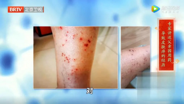 乾咳、下肢腫、面板癢?可能和你吃的藥有關!專家帶來小妙招 乾咳、下肢腫、面板癢?可能和你吃的藥有關!專家帶來小妙招